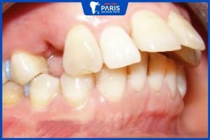 Phẫu thuật hàm hô có đau không? 8 Điều bắt buộc ghi nhớ