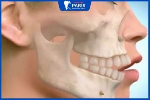 Bệnh Viện Phẫu Thuật Chỉnh Hàm Hô ở Hà Nội chuyên nghiệp và uy tín
