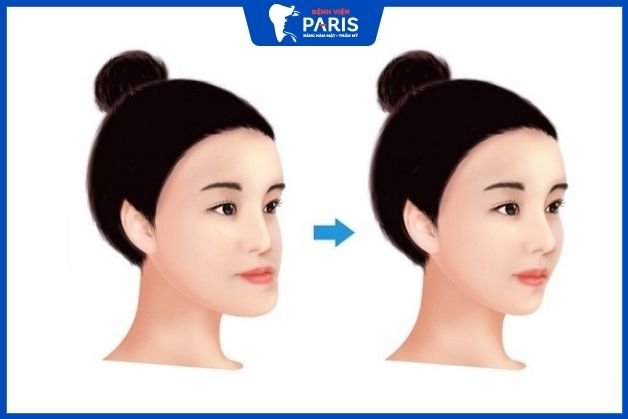 Phẫu thuật hàm móm giúp khắc phục tình trạng sai lệch khớp cắn