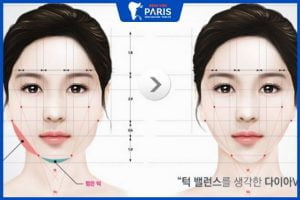 Phẫu thuật hàm vuông và 10 điều cần biết về hàm vuông