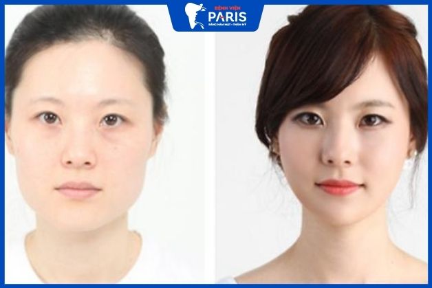 Sau gọt xương hàm khuôn mặt thon gọn hơn