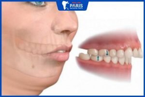 Phẫu thuật hô hàm trên – giải pháp tối ưu cho Hô hàm và hô răng