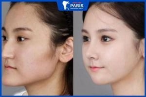 Phẫu thuật miệng móm – có đau không- có phức tạp không