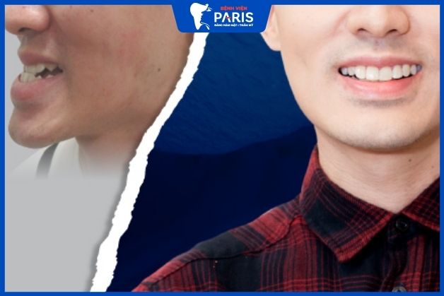 Khách hàng Nguyễn Quang Huy sau khi phẫu thuật hàm móm tại Bệnh Viện Răng Hàm Mặt thẩm mỹ Paris