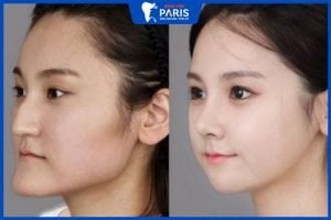 Phẫu thuật thẩm mỹ chỉnh hàm móm có đau không? – 3 lưu ý quan trọng
