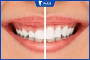 Thẩm mỹ cười hở lợi giá đắt không? Bao lâu có 1 nụ cười đẹp?