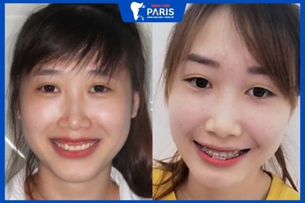 Khách hàng Lê Thị Hiền niềng răng chữa cười hở lợi