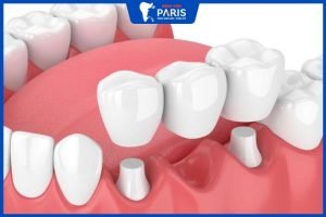 Trồng răng bắc cầu có tốt không – giải pháp cho người bị mất răng