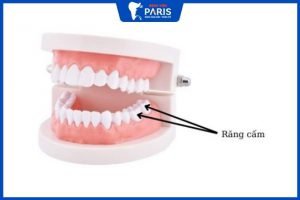 Trồng răng cấm là gì? có đau không, Giá bao nhiêu