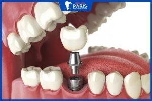 Trồng răng số 6 có đau không? Giá Bao Nhiêu? Bảng Giá Mới