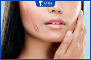 4 Loại sẹo thường gặp và 12 cách trị sẹo lâu năm, an toàn