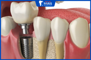 Trồng răng số 7 như thế nào? Phương pháp trồng răng số 7 nào tốt?