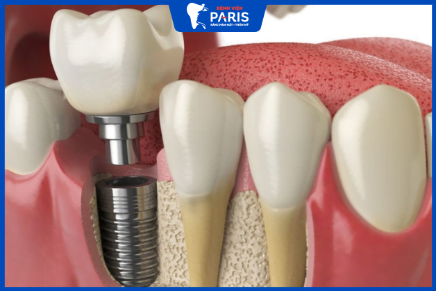Trồng răng số 7 bằng cấy ghép Implant