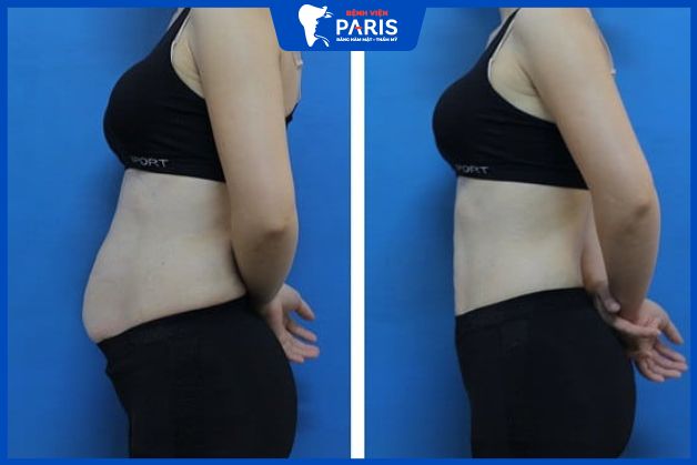 Hút mỡ an toàn tại Paris