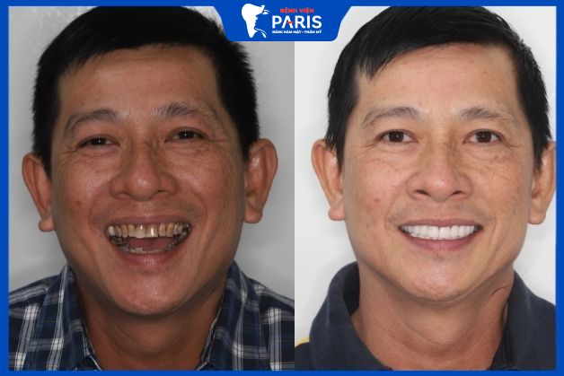 Khách hàng khắc phục được tình trạng răng ố vàng sau khi bọc mão sứ