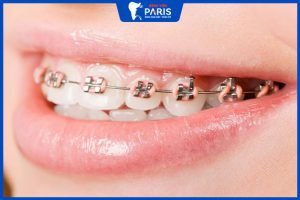 Niềng răng hàm trên hết bao nhiêu tiền- Các trường hợp nên niềng