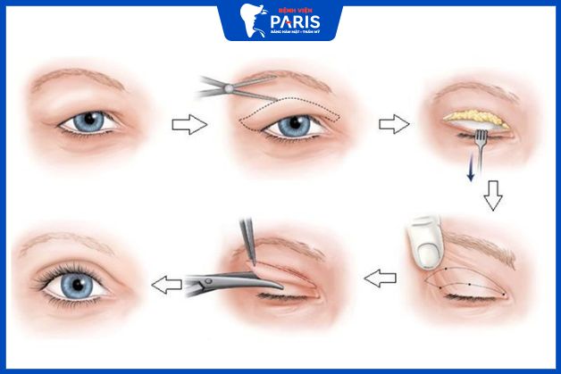 Kỹ thuật thẩm mỹ cắt mí mắt