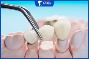 Cầu răng sứ có bền không, thời gian sử dụng bao lâu