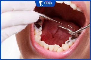 Có nên nhổ răng số 6 không? Quy trình và chi phí thực hiện