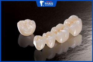 Răng toàn sứ: 6 dòng răng sứ tốt nhất trên thị trường