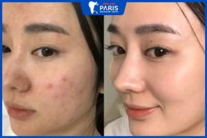 Điều trị mụn như thế nào – 5 Cách điều trị mụn dứt điểm