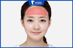 Độn trán có nguy hiểm hay không? Chi phí hết bao nhiêu tiền