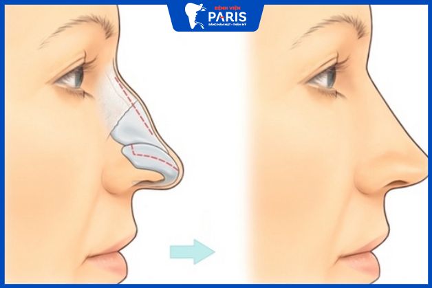 Tiêm chất làm đầy phù hợp với người cằm gãy