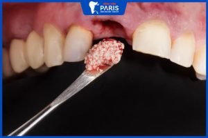 Ghép xương răng – Tổng hợp các kỹ thuật và biến chứng có thể xảy ra