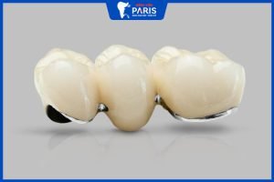 Răng sứ Titan có tốt không – Giá bao nhiêu