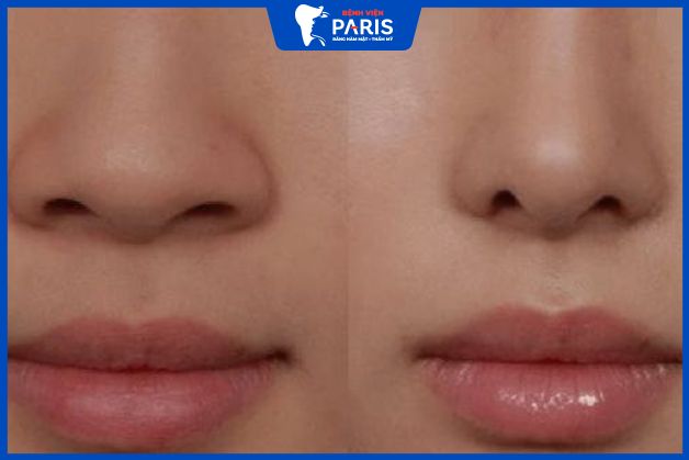 Kết quả thực tế của khách hàng trước và sau thu gọn đầu mũi tại Bệnh viện Paris
