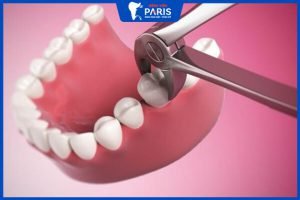 Nhổ răng hàm có đau không? Giá bao nhiêu