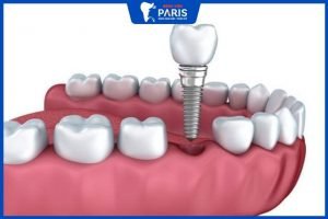 Tổng hợp 9 kinh nghiệm đi trồng răng Implant
