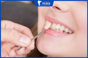 Dán răng sứ Veneer: 5 lợi ích khi phục hình dán răng sứ