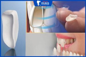 Mặt dán sứ Veneer Ultrathin có tốt không? Phù hợp với những ai?