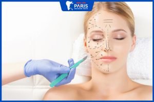 Nâng hạ gò má ai nên thực hiện? Chi phí hết bao nhiêu