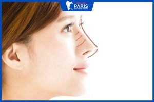 Nâng mũi thẩm mỹ hết bao nhiêu tiền? 5 phương pháp phổ biến