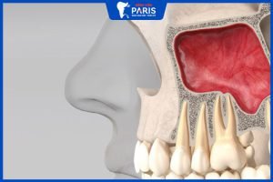 Nâng xoang: nâng xoang kín và nâng xoang hở, những lưu ý quan trọng