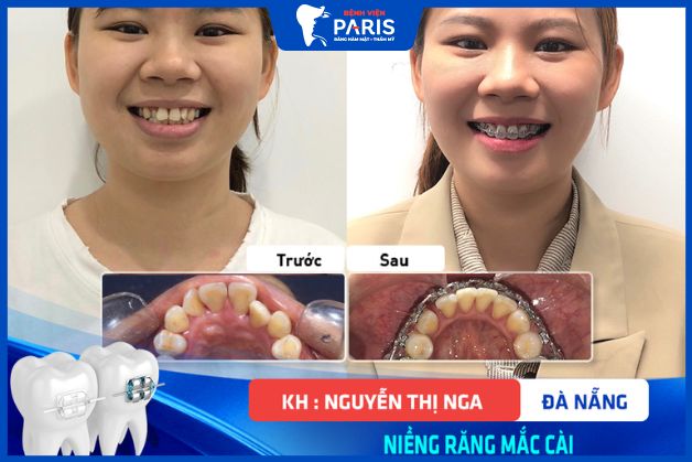 Hình ảnh khách hàng sau khi niềng răng tại nha khoa