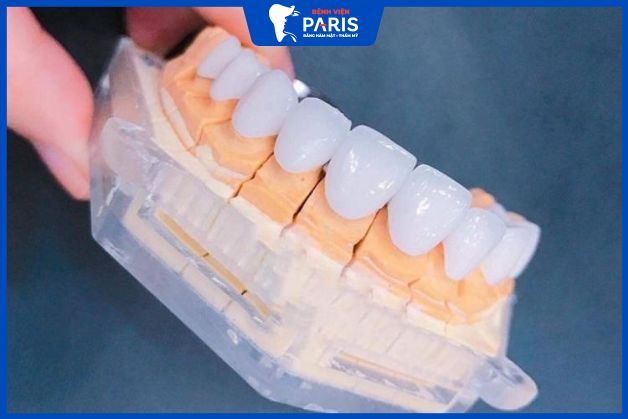 Răng sứ được bảo hành dài hạn