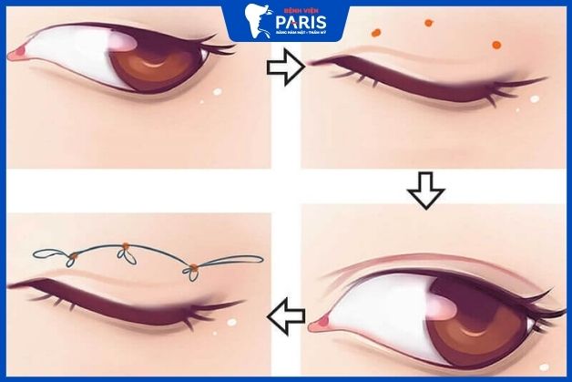 Bấm mí chỉ áp dụng được với tình trạng chưa có mỡ thừa, da chùng