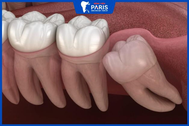 Nhổ răng khôn mọc lệch thường có chi phí cao hơn