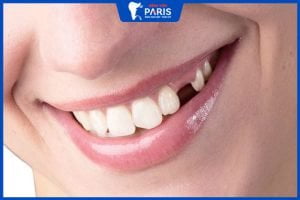 Nhổ răng nanh có gây đau nhức không? Chi phí hết bao nhiêu?
