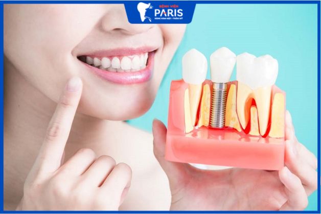 Trồng răng nanh bằng kỹ thuật cấy ghép Implant