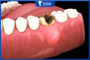 Nhổ răng sâu có đau không, khi nào cần nhổ, Giá bao nhiêu