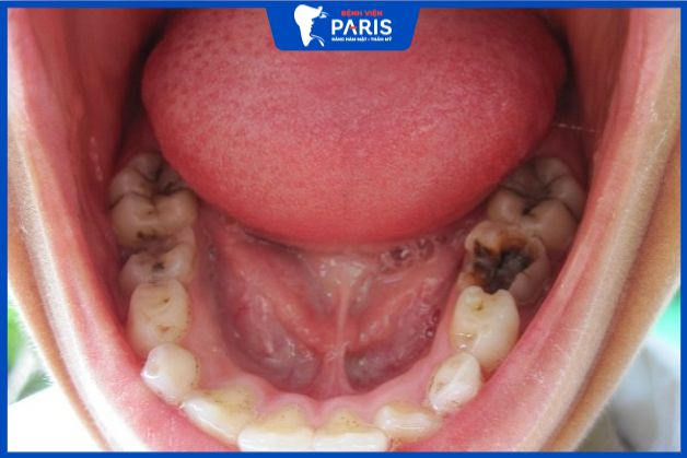 Nhổ răng số 7 khi bị sâu răng nặng