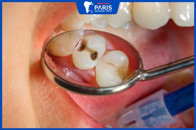 Những lưu ý khi nhổ răng sâu