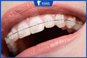 Niềng răng mắc cài trong suốt – giải pháp thẩm mỹ cao, hiệu quả
