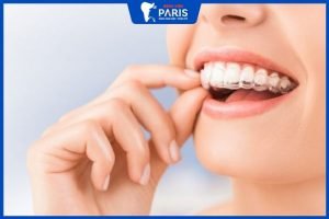 Niềng răng trong suốt có đau không? Chi phí hết bao nhiêu tiền?