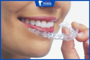 Niềng răng trong suốt Invisalign: Chi phí bao nhiêu? Phù hợp với ai