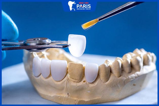 Răng bị gì thì nên dán sứ Veneer?